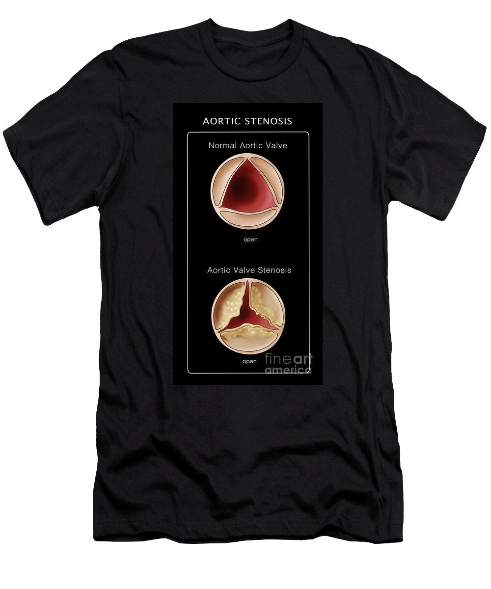1 Aortic Valve Normal Stenosis Monica Schroeder T-Shirt
